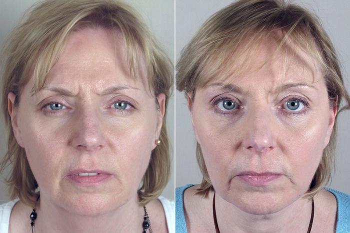 Neck Contouring Case 224 Before & After View #1 | Paramus, New Jersey | Parker Center for Plastic Surgery