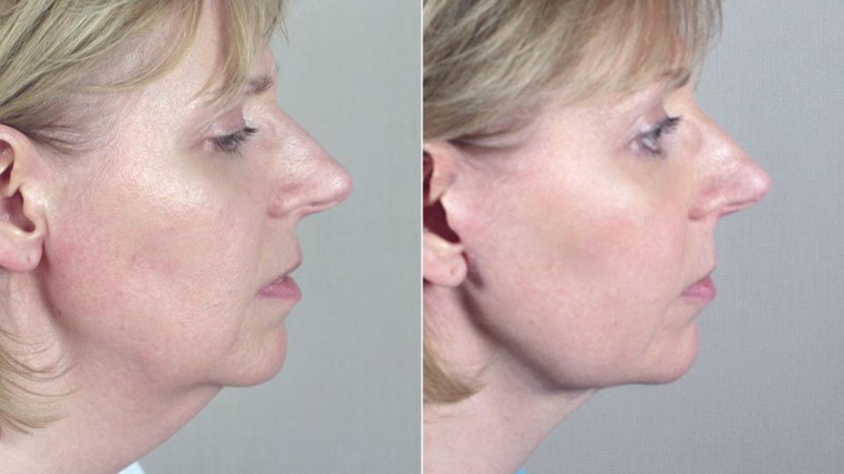 Neck Contouring Case 224 Before & After View #2 | Paramus, New Jersey | Parker Center for Plastic Surgery