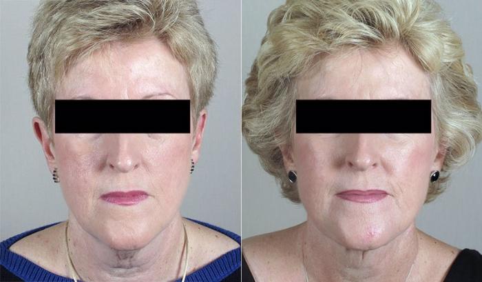 Neck Contouring Case 225 Before & After View #1 | Paramus, New Jersey | Parker Center for Plastic Surgery
