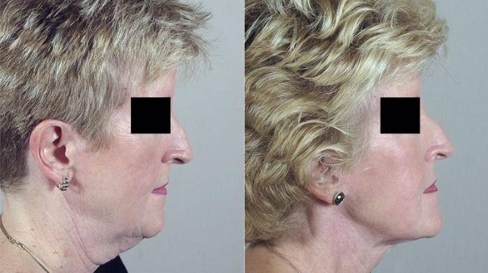 Neck Contouring Case 225 Before & After View #2 | Paramus, New Jersey | Parker Center for Plastic Surgery