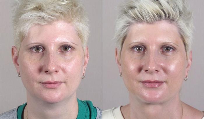 Neck Contouring Case 226 Before & After View #1 | Paramus, New Jersey | Parker Center for Plastic Surgery