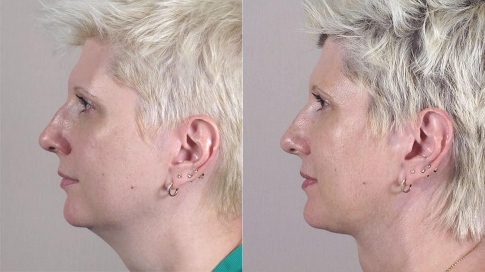 Neck Contouring Case 226 Before & After View #2 | Paramus, New Jersey | Parker Center for Plastic Surgery