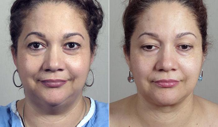 Neck Contouring Case 229 Before & After View #1 | Paramus, New Jersey | Parker Center for Plastic Surgery