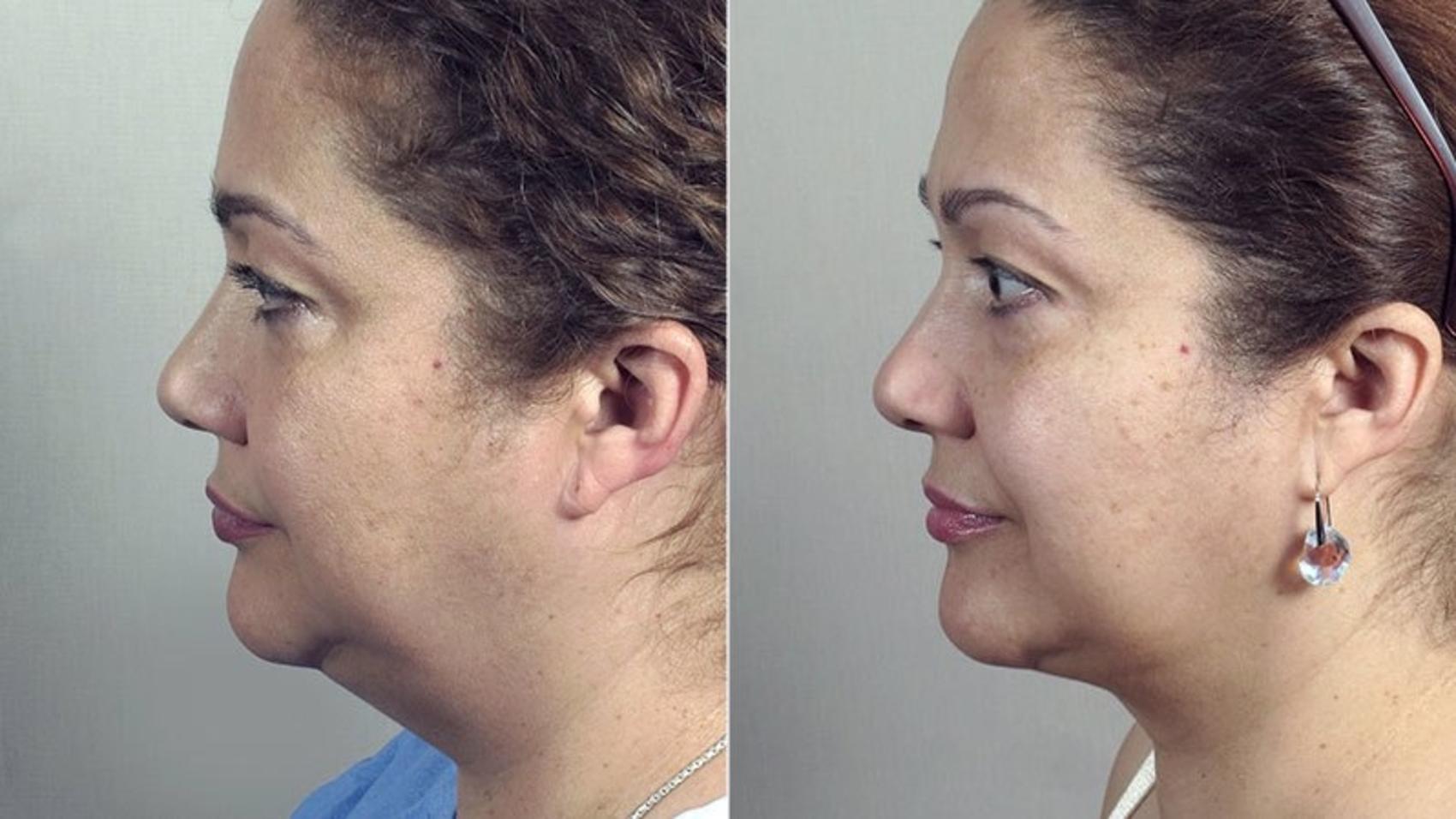 Neck Contouring Case 229 Before & After View #2 | Paramus, New Jersey | Parker Center for Plastic Surgery