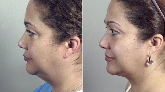 Neck Contouring Case 229 Before & After View #2 | Paramus, New Jersey | Parker Center for Plastic Surgery