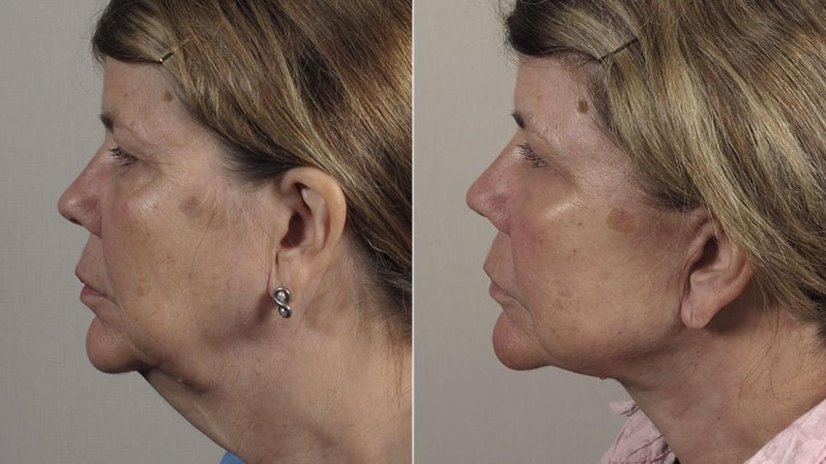 Neck Contouring Case 230 Before & After View #1 | Paramus, New Jersey | Parker Center for Plastic Surgery