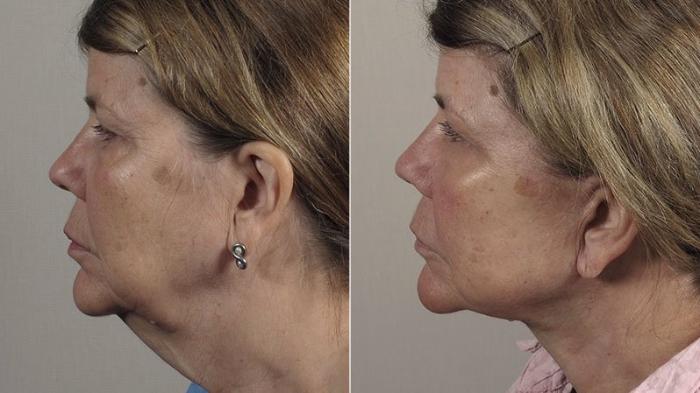 Neck Contouring Case 230 Before & After View #1 | Paramus, New Jersey | Parker Center for Plastic Surgery