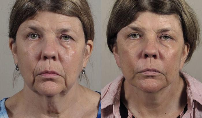 Neck Contouring Case 230 Before & After View #2 | Paramus, New Jersey | Parker Center for Plastic Surgery