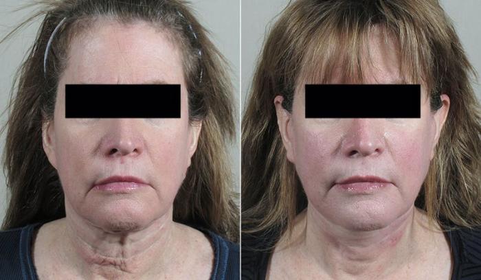 Neck Contouring Case 231 Before & After View #1 | Paramus, New Jersey | Parker Center for Plastic Surgery