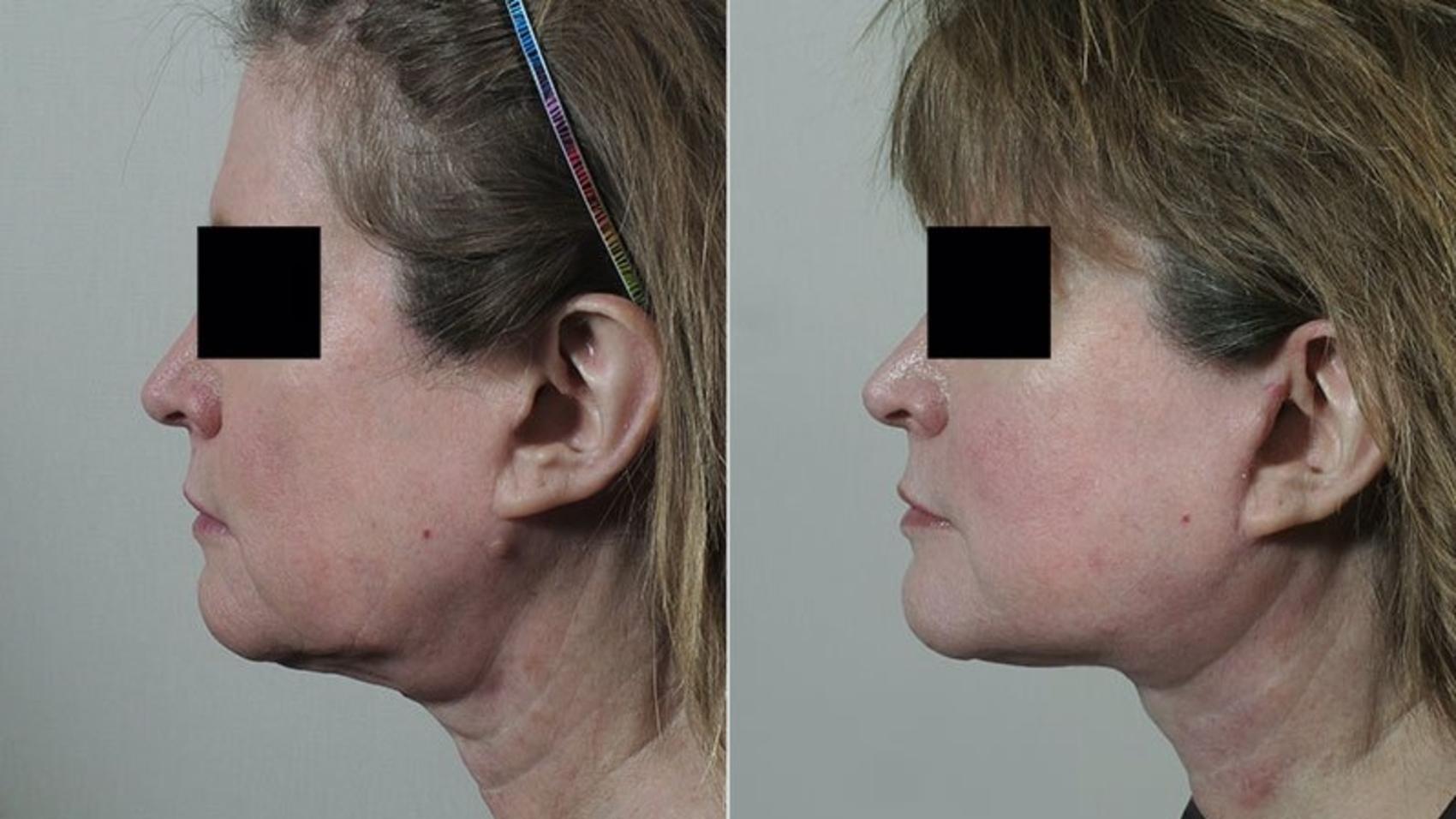 Neck Contouring Case 231 Before & After View #2 | Paramus, New Jersey | Parker Center for Plastic Surgery