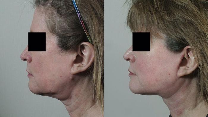 Neck Contouring Case 231 Before & After View #2 | Paramus, New Jersey | Parker Center for Plastic Surgery