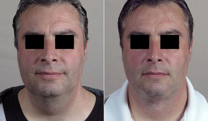 Neck Contouring Case 232 Before & After View #1 | Paramus, New Jersey | Parker Center for Plastic Surgery