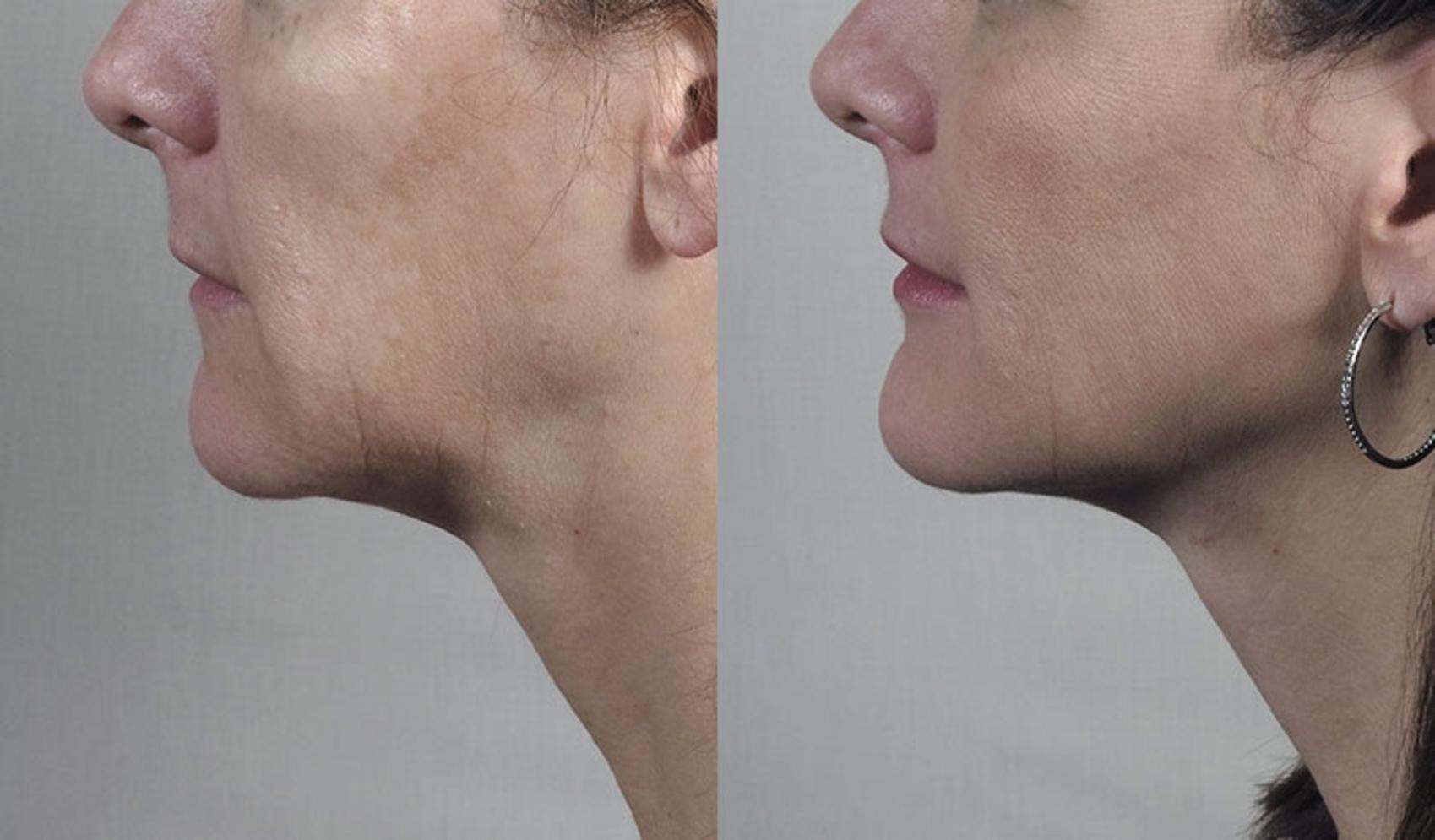 Neck Contouring Case 888 Before & After View #4 | Paramus, New Jersey | Parker Center for Plastic Surgery