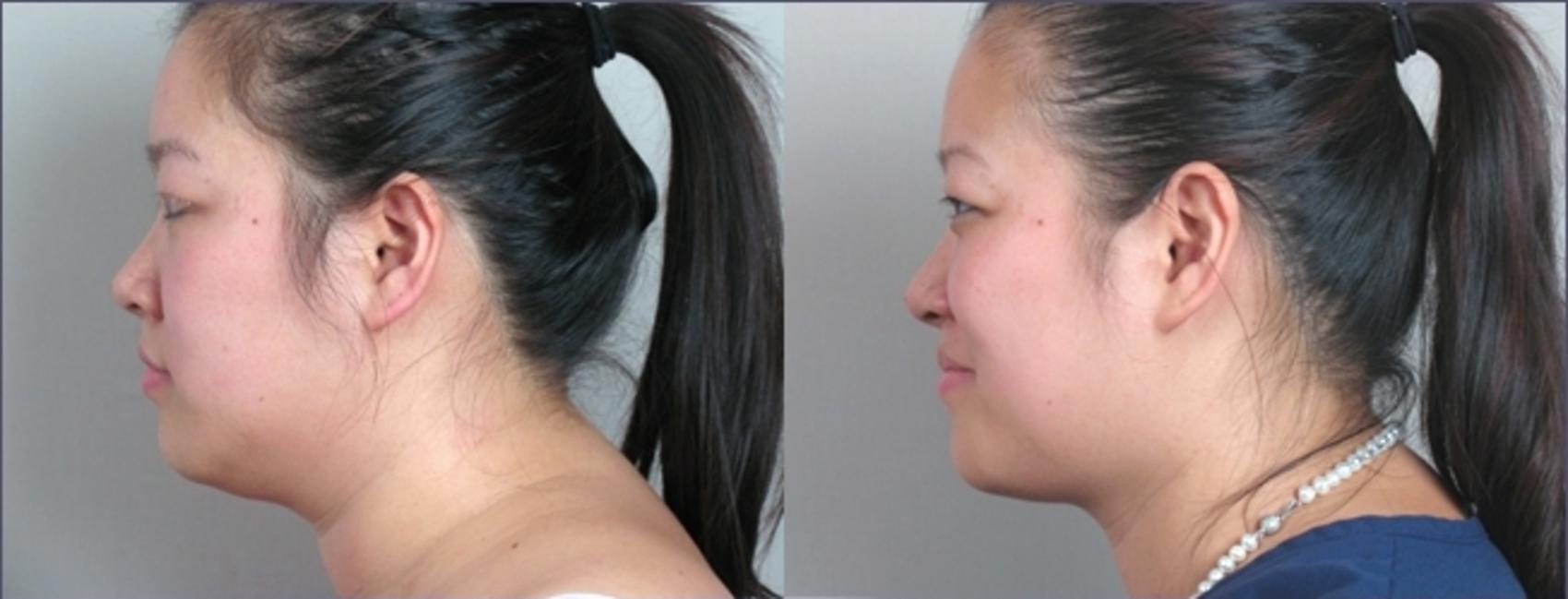 Neck Contouring Case 914 Before & After View #5 | Paramus, New Jersey | Parker Center for Plastic Surgery