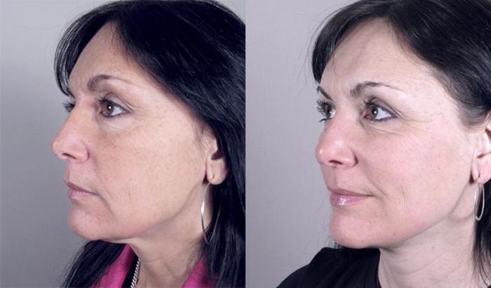 Neck Contouring Case 916 Before & After Left Oblique | Paramus, New Jersey | Parker Center for Plastic Surgery