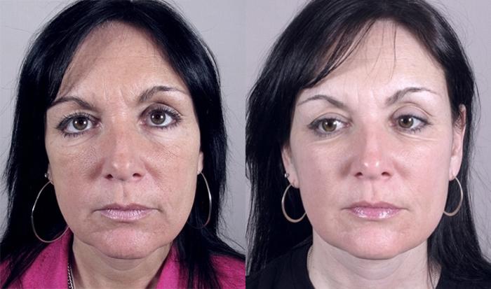 Neck Contouring Case 916 Before & After View #5 | Paramus, New Jersey | Parker Center for Plastic Surgery
