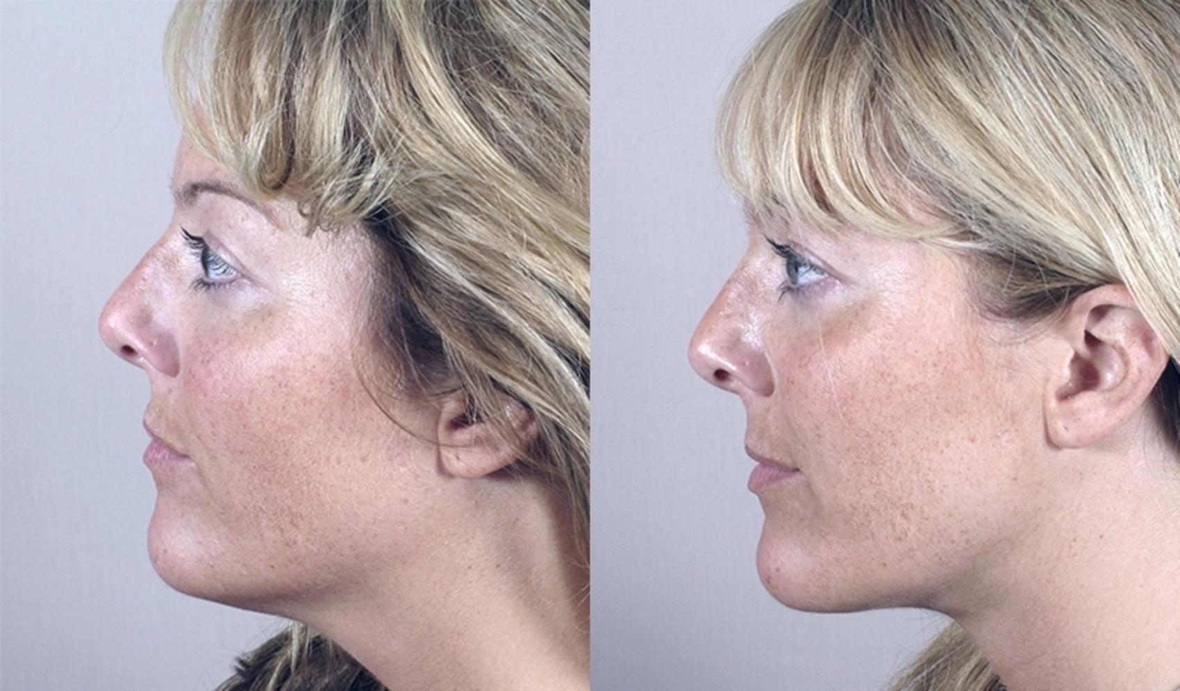 Neck Contouring Case 917 Before & After View #5 | Paramus, New Jersey | Parker Center for Plastic Surgery