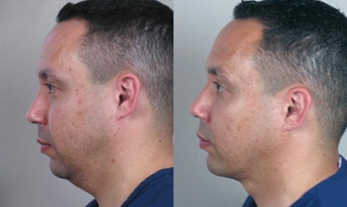 Neck Contouring Case 946 Before & After View #5 | Paramus, New Jersey | Parker Center for Plastic Surgery