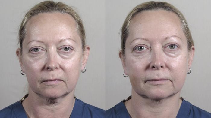 Neck Contouring Case 986 Before & After Front | Paramus, New Jersey | Parker Center for Plastic Surgery