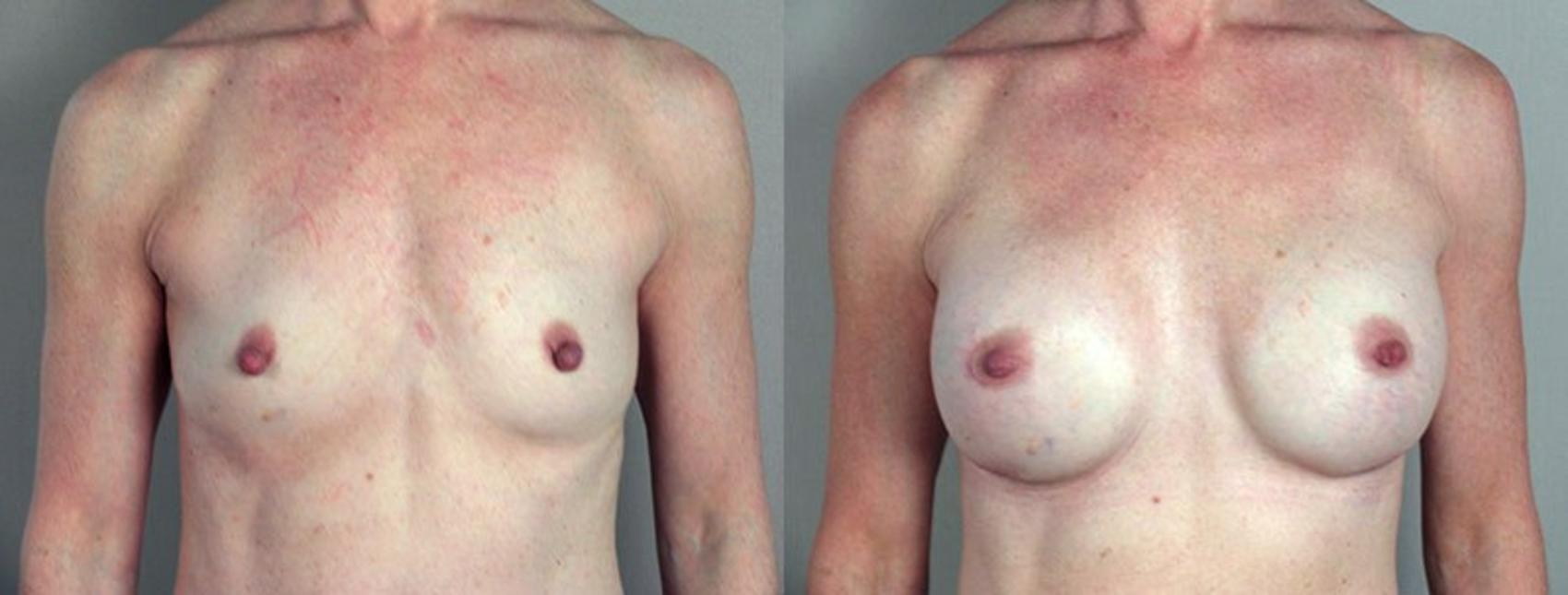 Nipple Procedures Case 363 Before & After View #1 | Paramus, New Jersey | Parker Center for Plastic Surgery