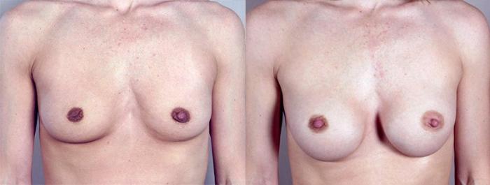 Nipple Procedures Case 368 Before & After View #1 | Paramus, New Jersey | Parker Center for Plastic Surgery