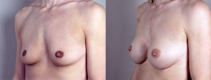 Nipple Procedures Case 368 Before & After View #2 | Paramus, New Jersey | Parker Center for Plastic Surgery