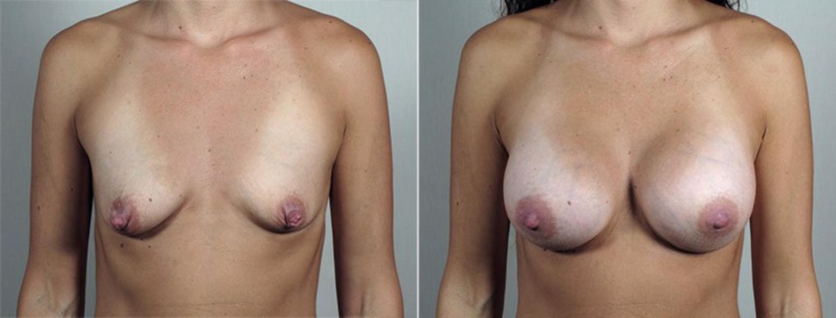 Nipple Procedures Case 429 Before & After View #1 | Paramus, New Jersey | Parker Center for Plastic Surgery