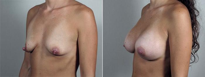 Nipple Procedures Case 429 Before & After View #2 | Paramus, New Jersey | Parker Center for Plastic Surgery