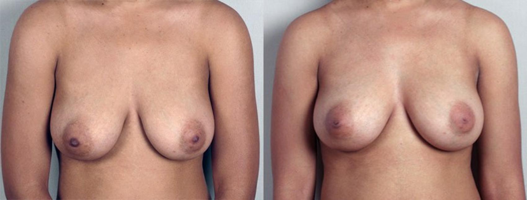 Nipple Procedures Case 559 Before & After View #1 | Paramus, New Jersey | Parker Center for Plastic Surgery