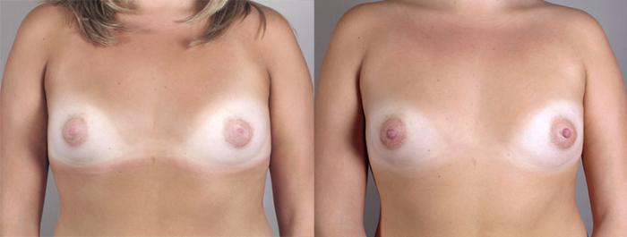 Nipple Procedures Case 560 Before & After View #1 | Paramus, New Jersey | Parker Center for Plastic Surgery