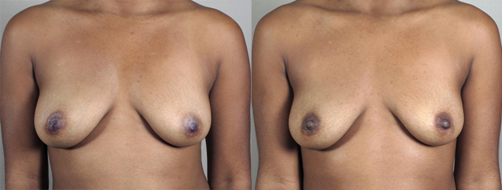 Nipple Procedures Case 561 Before & After View #1 | Paramus, New Jersey | Parker Center for Plastic Surgery