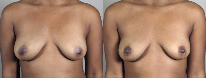 Nipple Procedures Case 561 Before & After View #1 | Paramus, New Jersey | Parker Center for Plastic Surgery