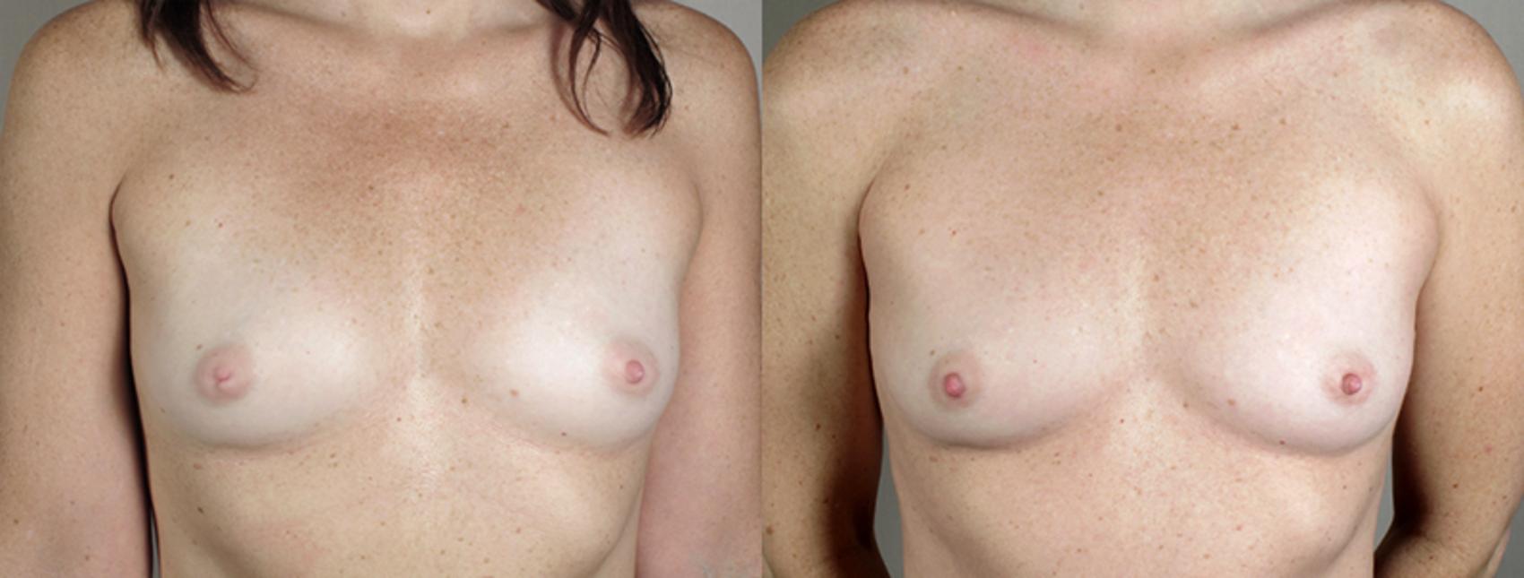 Nipple Procedures Case 562 Before & After View #1 | Paramus, New Jersey | Parker Center for Plastic Surgery