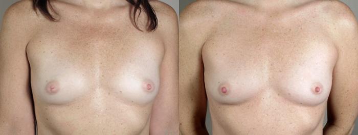 Nipple Procedures Case 562 Before & After View #1 | Paramus, New Jersey | Parker Center for Plastic Surgery