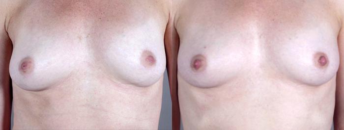 Nipple Procedures Case 563 Before & After View #1 | Paramus, New Jersey | Parker Center for Plastic Surgery