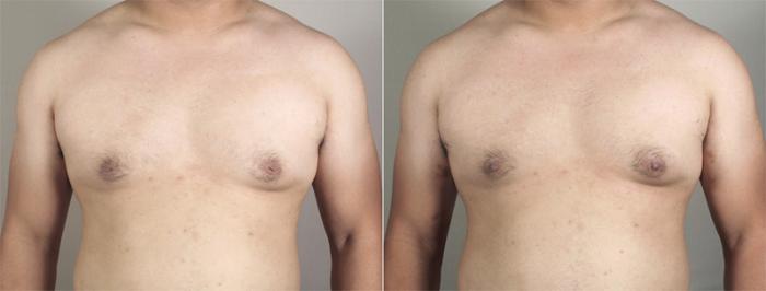 Nipple Procedures Case 565 Before & After View #1 | Paramus, New Jersey | Parker Center for Plastic Surgery