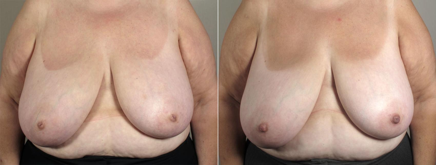Nipple Procedures Case 566 Before & After View #1 | Paramus, New Jersey | Parker Center for Plastic Surgery