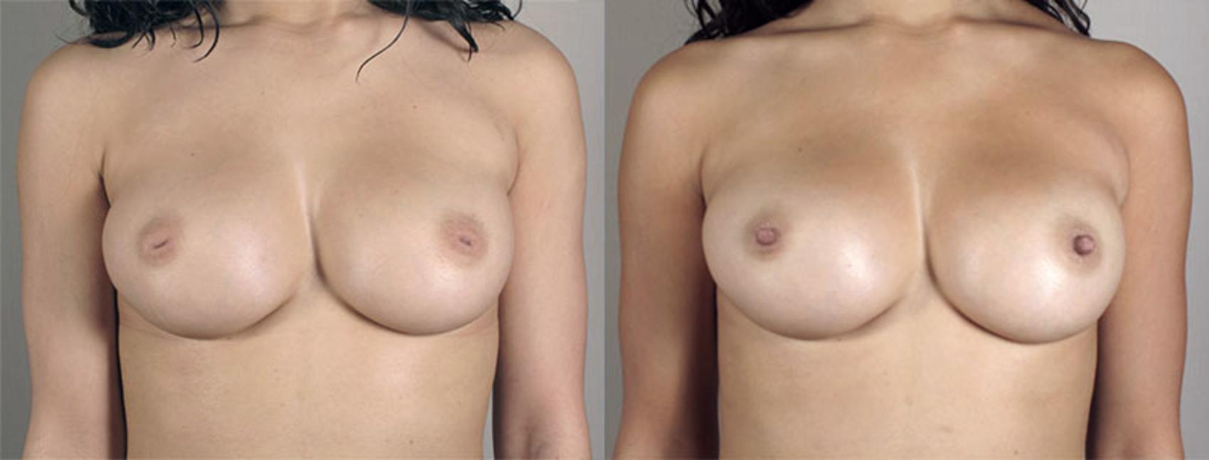 Nipple Procedures Case 567 Before & After View #1 | Paramus, New Jersey | Parker Center for Plastic Surgery