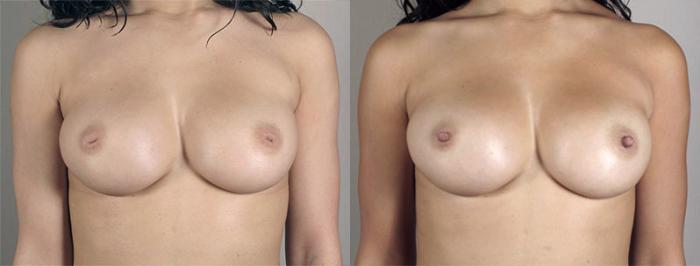 Nipple Procedures Case 567 Before & After View #1 | Paramus, New Jersey | Parker Center for Plastic Surgery