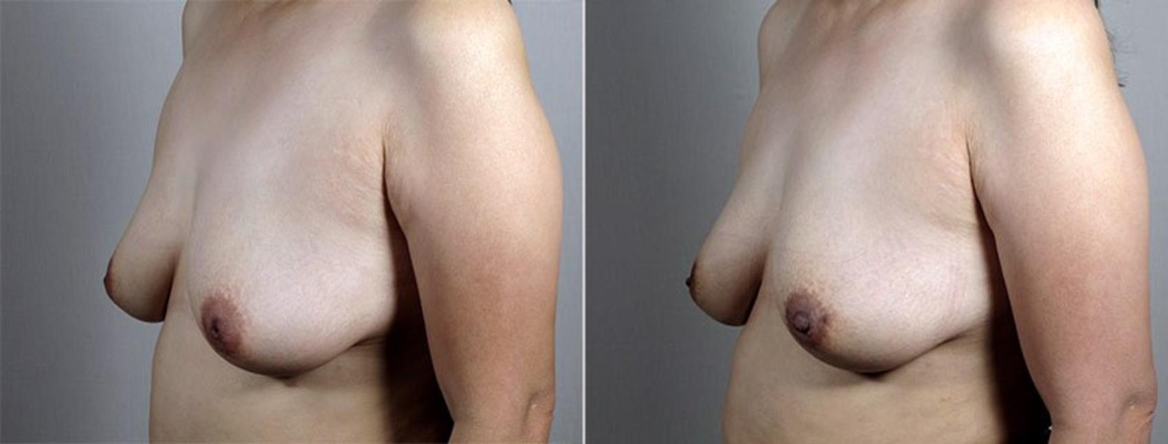 Nipple Procedures Case 568 Before & After View #1 | Paramus, New Jersey | Parker Center for Plastic Surgery