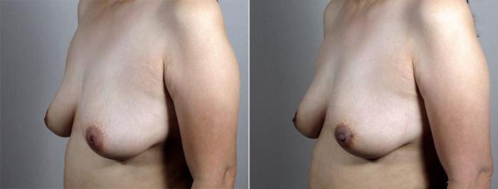 Nipple Procedures Case 568 Before & After View #1 | Paramus, New Jersey | Parker Center for Plastic Surgery