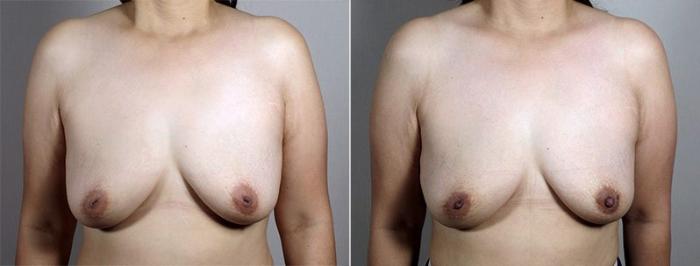 Nipple Procedures Case 568 Before & After View #2 | Paramus, New Jersey | Parker Center for Plastic Surgery