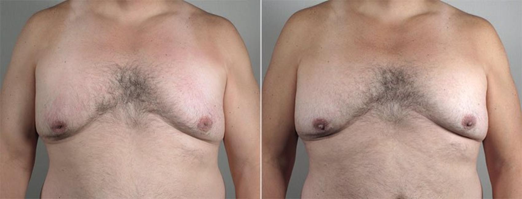 Nipple Procedures Case 569 Before & After View #1 | Paramus, New Jersey | Parker Center for Plastic Surgery