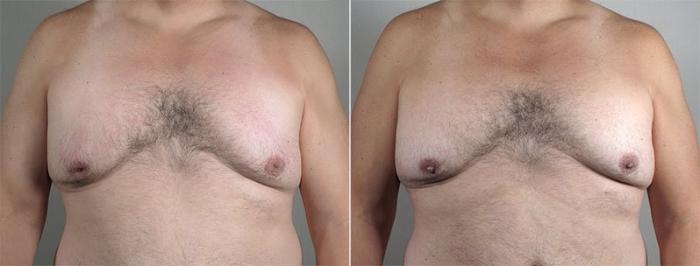 Nipple Procedures Case 569 Before & After View #1 | Paramus, New Jersey | Parker Center for Plastic Surgery