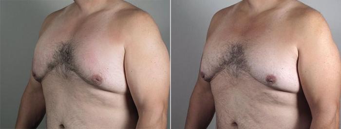 Nipple Procedures Case 569 Before & After View #2 | Paramus, New Jersey | Parker Center for Plastic Surgery