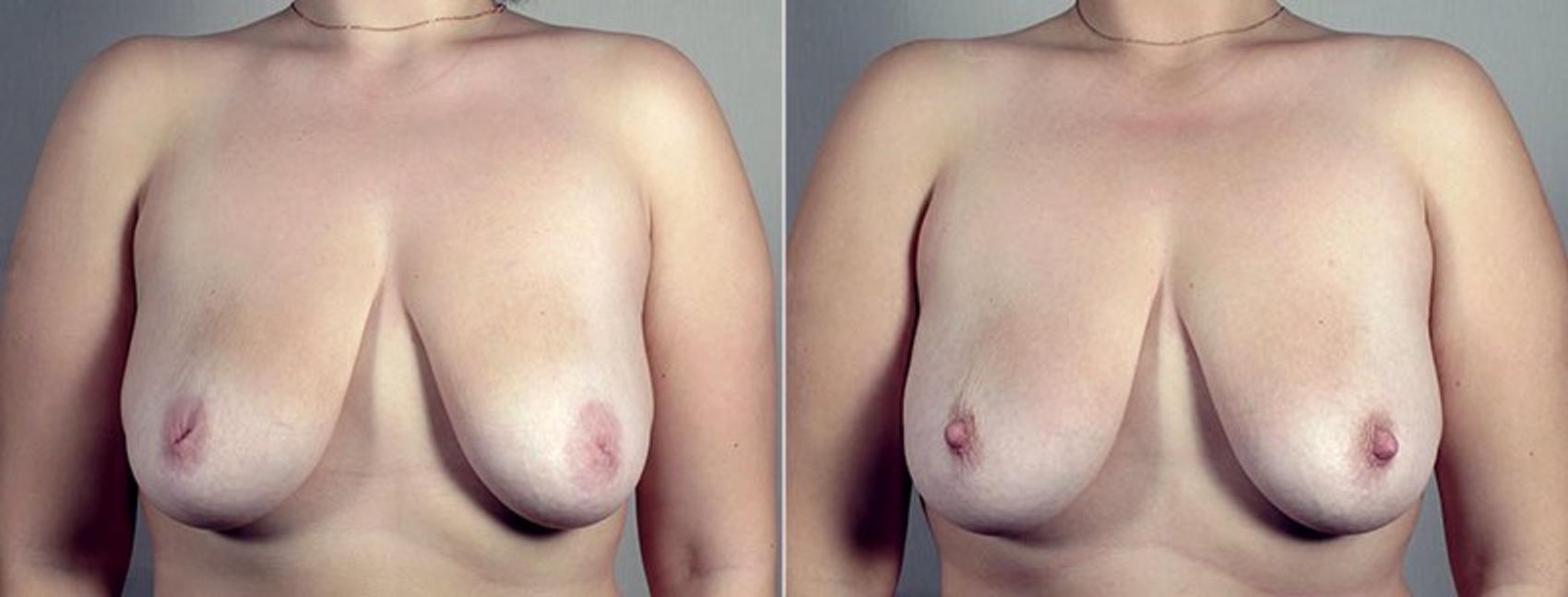 Nipple Procedures Case 570 Before & After View #1 | Paramus, New Jersey | Parker Center for Plastic Surgery