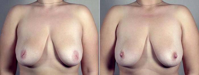 Nipple Procedures Case 570 Before & After View #1 | Paramus, New Jersey | Parker Center for Plastic Surgery