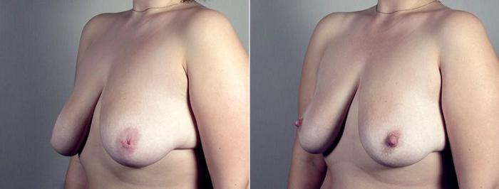 Nipple Procedures Case 570 Before & After View #2 | Paramus, New Jersey | Parker Center for Plastic Surgery