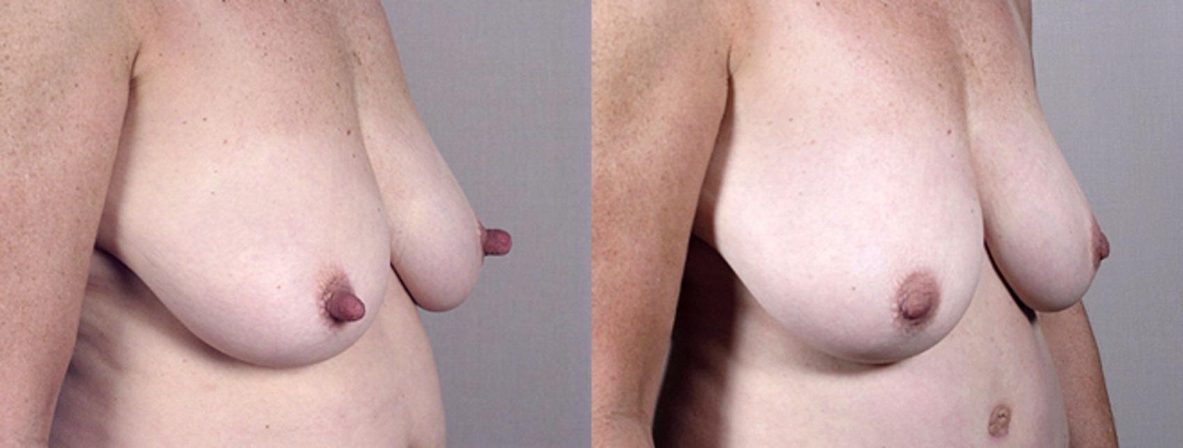 Nipple Procedures Case 571 Before & After View #1 | Paramus, New Jersey | Parker Center for Plastic Surgery