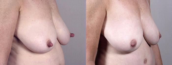 Nipple Procedures Case 571 Before & After View #1 | Paramus, New Jersey | Parker Center for Plastic Surgery